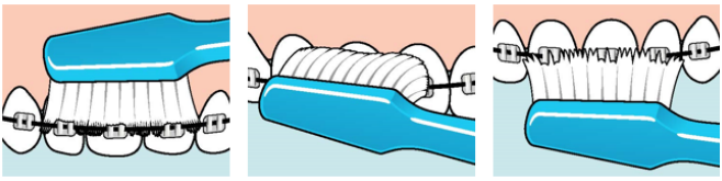 Bilder som visar hur tandborsten ska ligga mot tänderna när man borstar