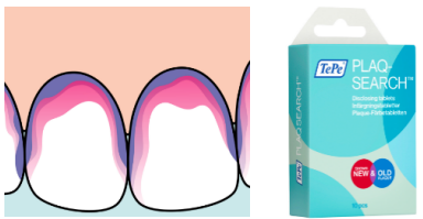 Bilder som visar tänder som har färgats för att upptäcka plack, samt en rekommenderad produkt för detta ändamål.